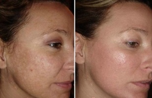 sejas ādas lāzera atjaunošana pirms un pēc fotogrāfijām
